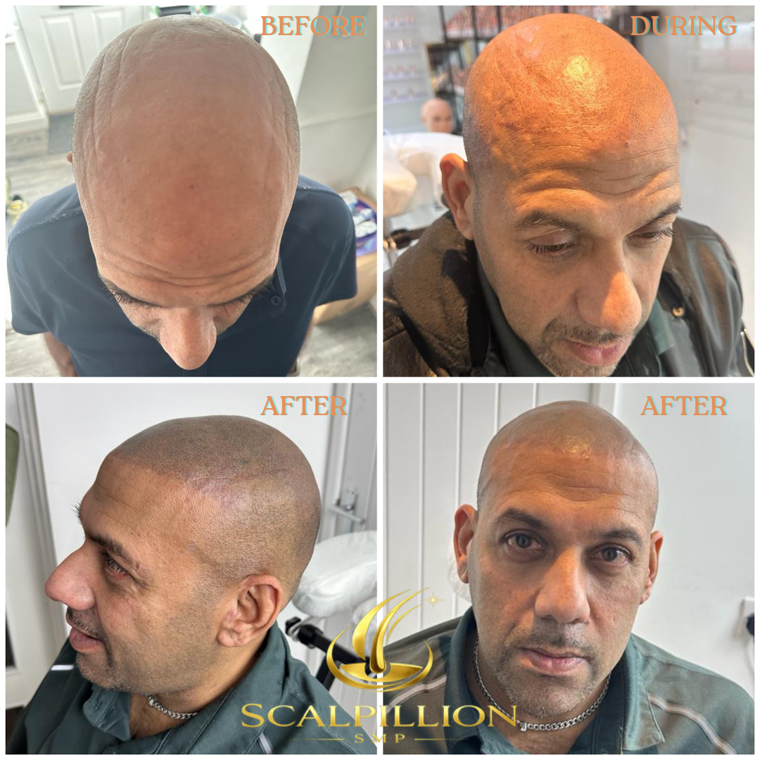scalpillion before and after