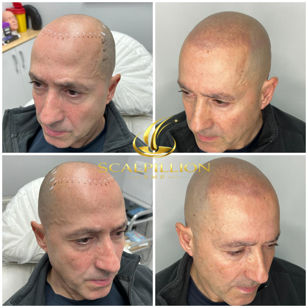 scalpillion hairline replacement
